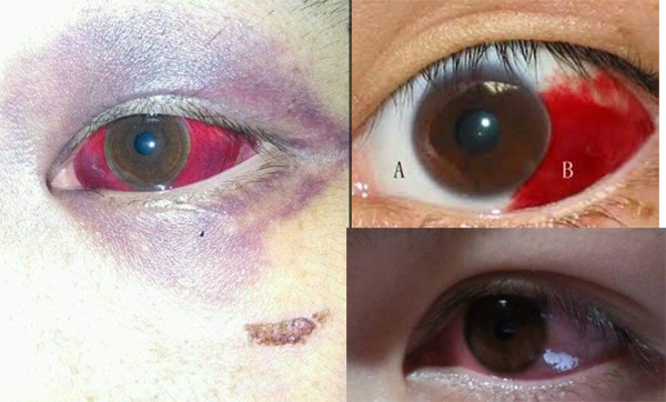 专家解读: 【直接咨询医生】 红眼的原因很多,疼痛是红眼的重要伴随