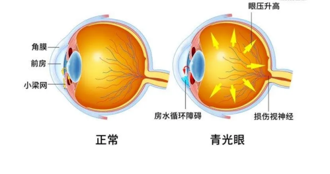 健康指南丨“视力小偷”青光眼，离你有多远？插图