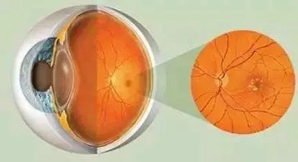 “黄斑”不是“斑”？眼科医生为你揭秘黄斑病！插图
