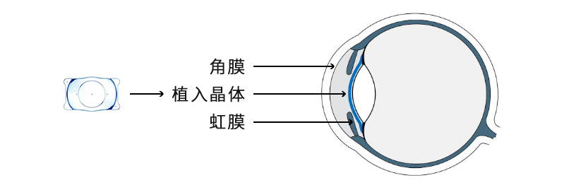 ICL晶体植入术：不一样的加法手术，这些人群更适合插图(2)